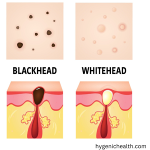 rids from blackheads