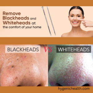rids from blackheads