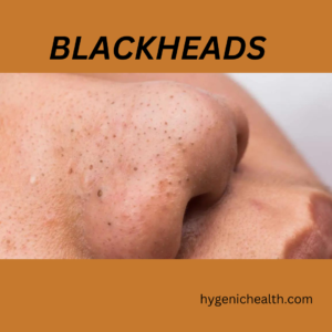 remove from blackheads